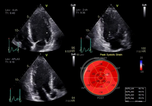 Клинические изображения Ультразвуковая диагностическая система GE HealthCare Vivid E95