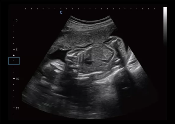 Клинические изображения УЗИ аппарат Chison CBit 9