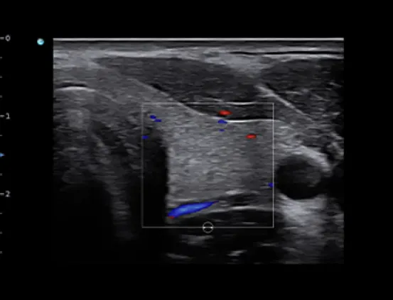 Клинические изображения УЗИ аппарат Chison SonoTouch 50 (Sonoair) портативный