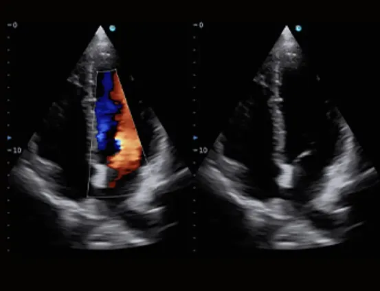Клинические изображения УЗИ аппарат Chison SonoTouch 50 (Sonoair) портативный