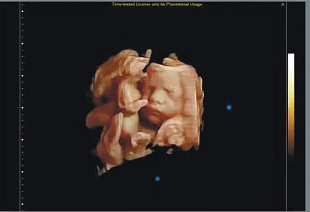 Клинические изображения УЗИ аппарат Chison Qbit 11