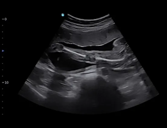 Клинические изображения УЗИ аппарат Chison SonoTouch 50 (Sonoair) портативный