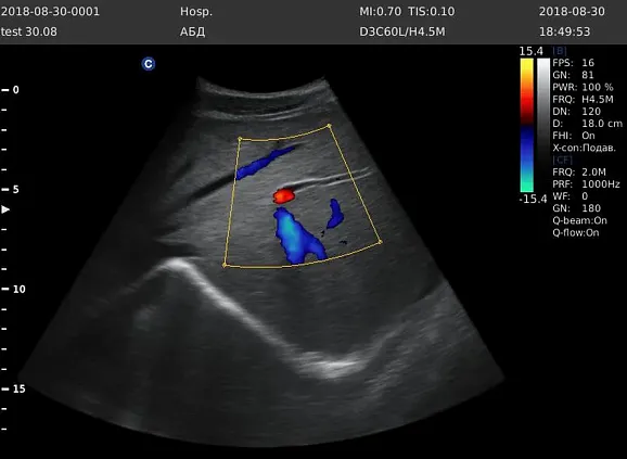 Клинические изображения УЗИ аппарат Chison Qbit 5