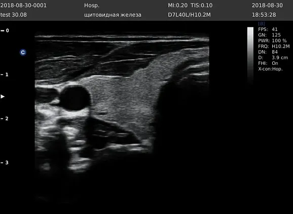 Клинические изображения УЗИ аппарат Chison Qbit 5