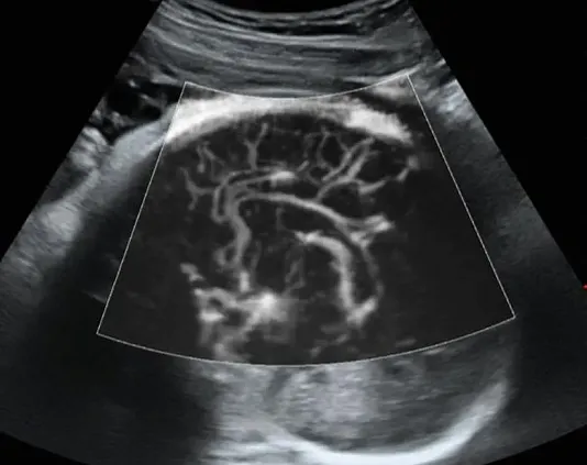 Клинические изображения Sonoscape S60 ультразвуковой аппарат